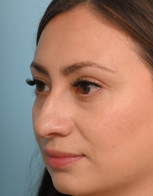 Rhinoplasty