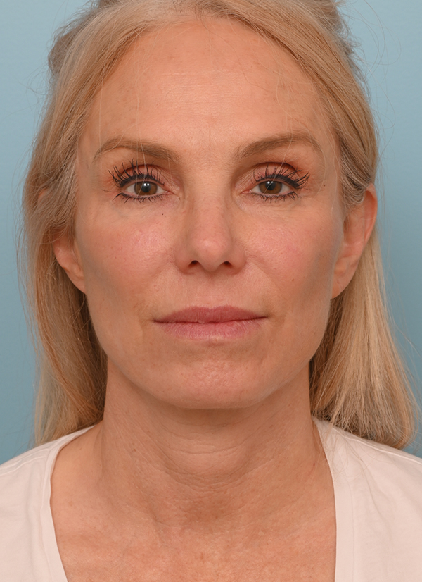 Face Lift/Neck Lift