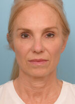 Face Lift/Neck Lift