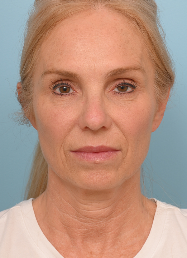 Face Lift/Neck Lift
