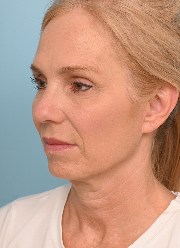 Face Lift/Neck Lift