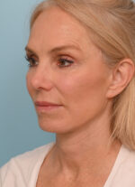 Face Lift/Neck Lift