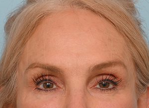 Brow Lift