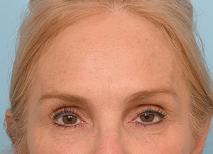 Brow Lift