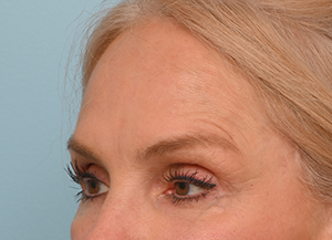 Brow Lift