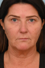 Face Lift/Neck Lift