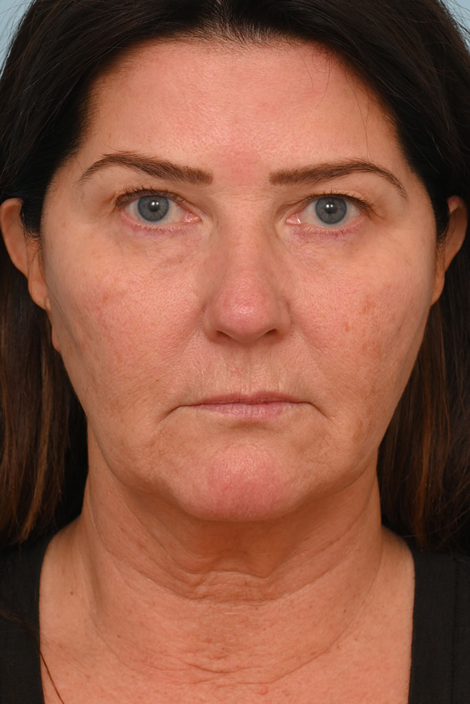 Face Lift/Neck Lift