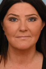Face Lift/Neck Lift