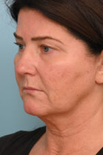 Face Lift/Neck Lift