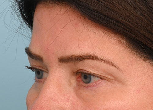 Brow Lift