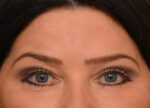Brow Lift