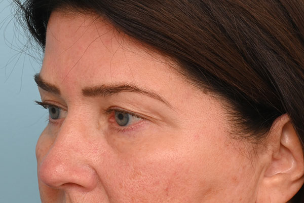 Eye Rejuvenation