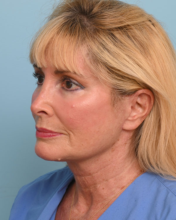 Facial Fat Transfer