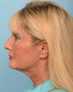Facial Fat Transfer