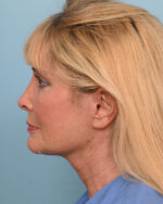 Facial Fat Transfer