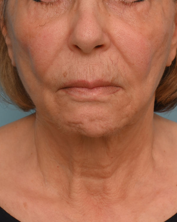 Face Lift/Neck Lift