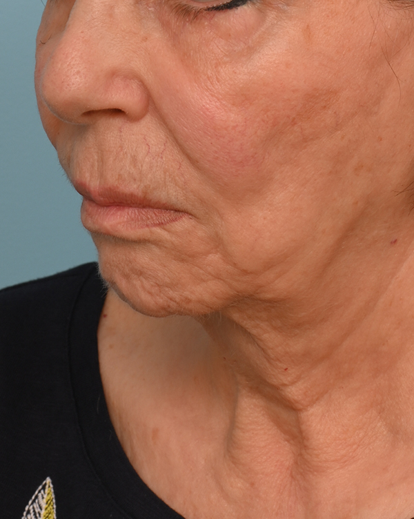 Face Lift/Neck Lift