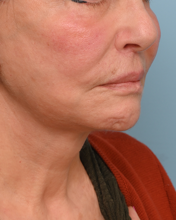 Face Lift/Neck Lift