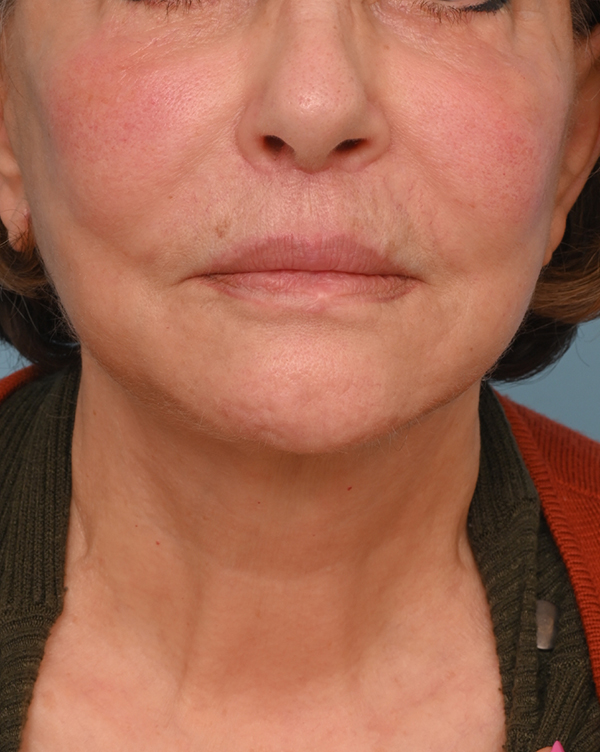 Face Lift/Neck Lift