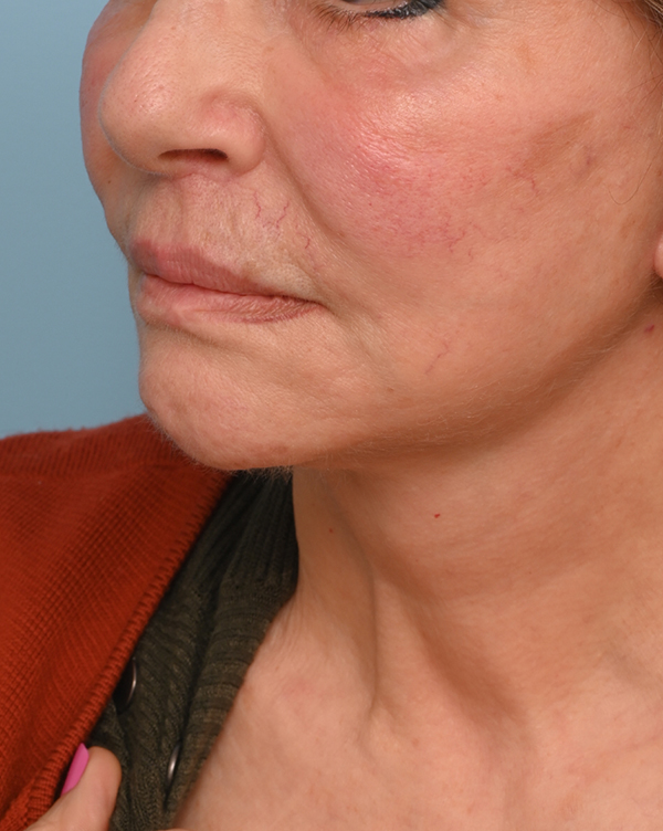 Face Lift/Neck Lift