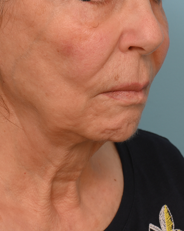 Face Lift/Neck Lift