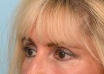 Brow Lift