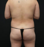 Body Liposuction