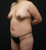 Body Liposuction