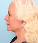 Face Lift/Neck Lift