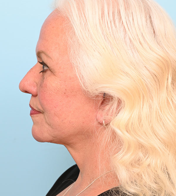 Face Lift/Neck Lift