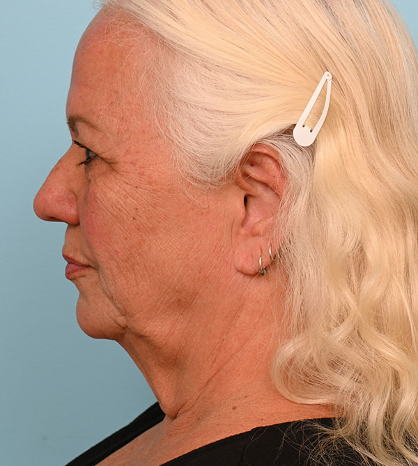 Face Lift/Neck Lift