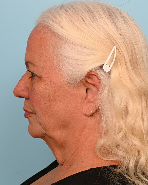 Facial Fat Transfer