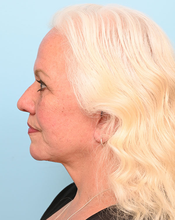 Facial Fat Transfer