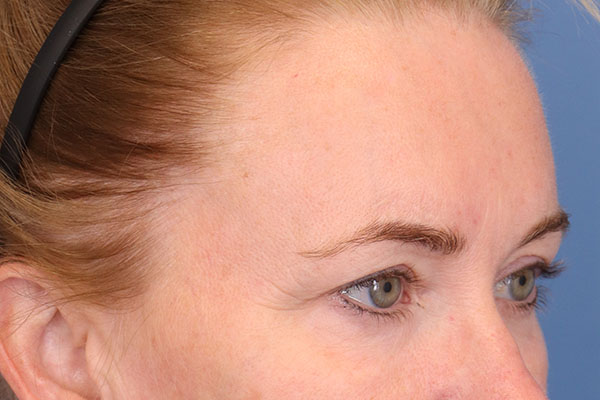 Brow Lift
