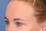 Brow Lift