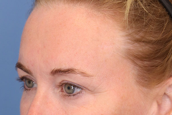 Brow Lift