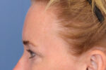 Brow Lift