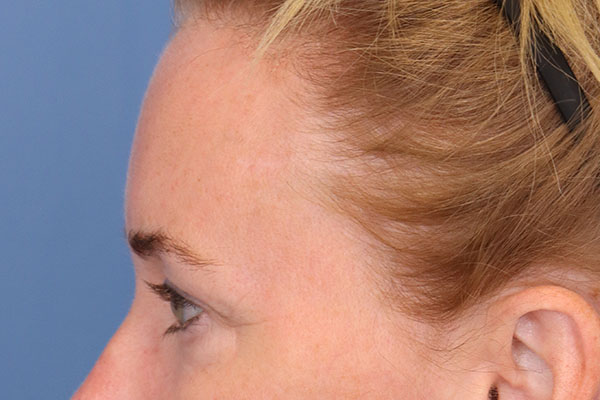 Brow Lift