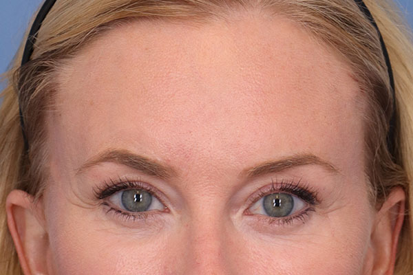 Brow Lift