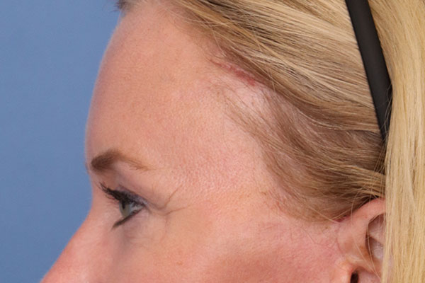 Brow Lift
