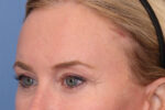 Brow Lift