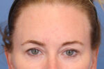 Brow Lift