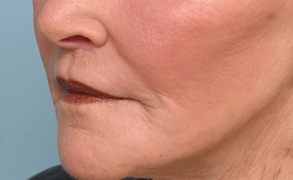 Lip Lift