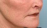 Lip Lift