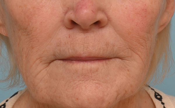 Lip Lift