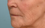 Lip Lift