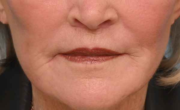 Lip Lift