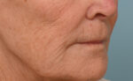 Lip Lift
