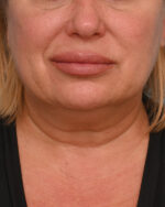 Face Lift/Neck Lift