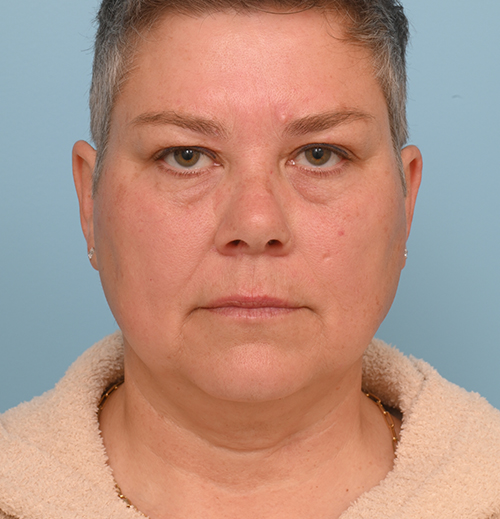Face Lift/Neck Lift